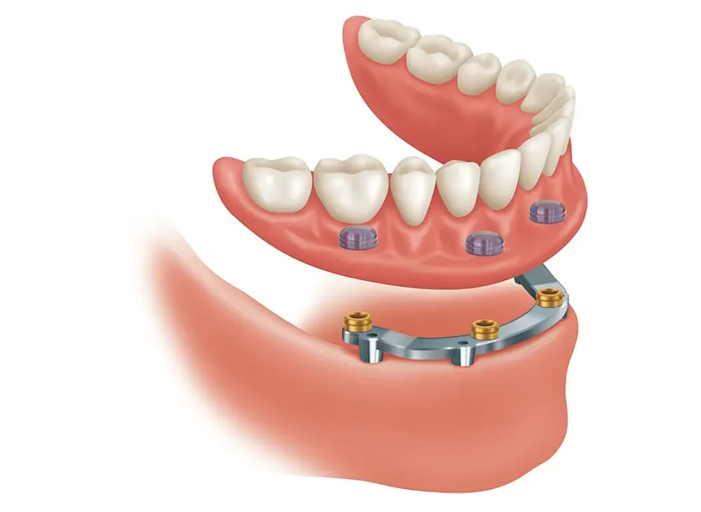 bar supported dentures