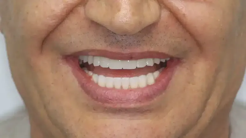 edg upland smilemakeover after 1