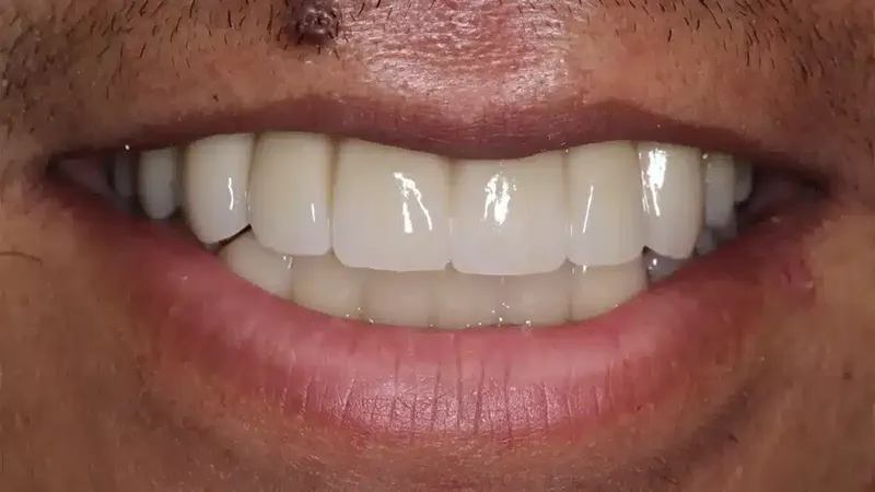 edg upland smilemakeover after 2