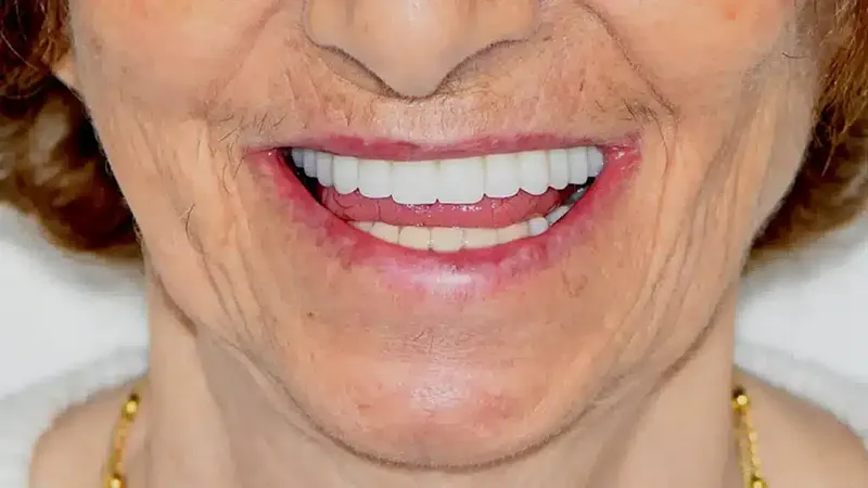 edg upland smilemakeover after 3