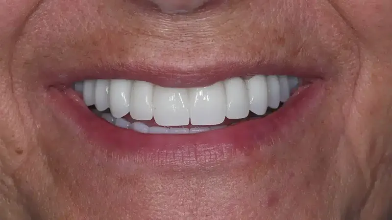 edg upland smilemakeover after 4