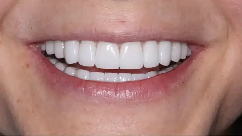 edg upland smilemakeover after 5