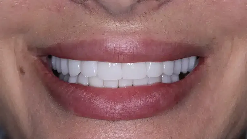 edg upland smilemakeover after 6
