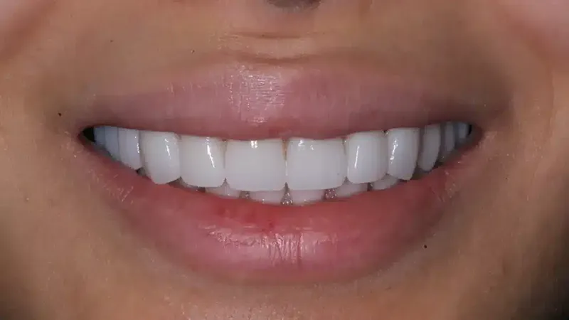 edg upland smilemakeover after 7