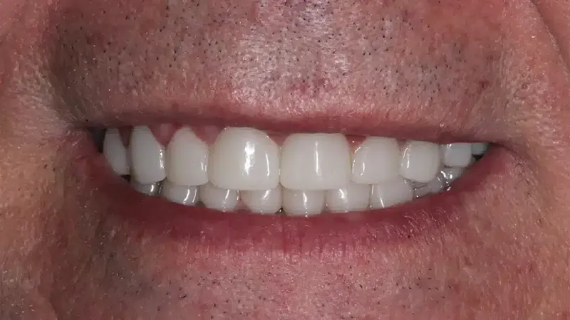 edg upland smilemakeover after 8