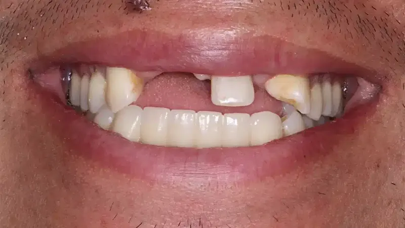 edg upland smilemakeover before 2