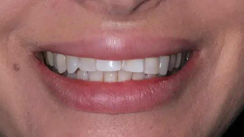 edg upland smilemakeover before 6